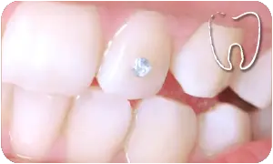 Brillantino sul dente bologna