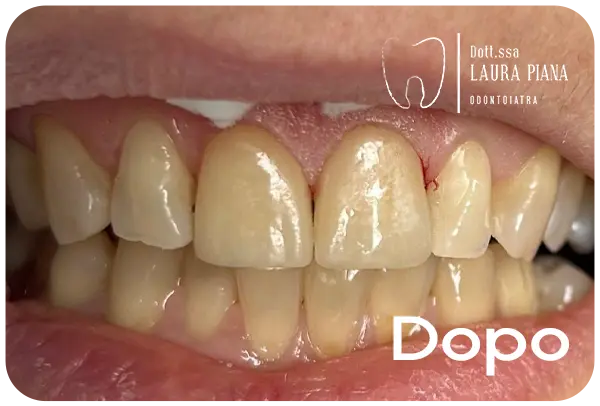 Faccette dentali bologna risultati dopo