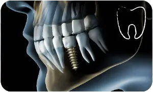 Impianti dentali Bologna