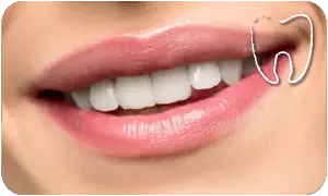 Intarsio dentale bologna dott.ssa Piana