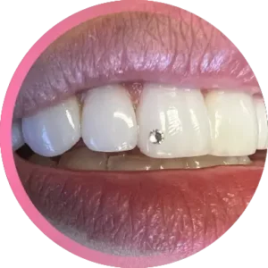 Brillantino dente bologna e provincia